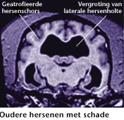 Door hersenbeschadiging kan dementie ontstaan.