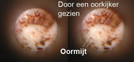 Oormijt door een oorkijker is goed in beeld te brengen
